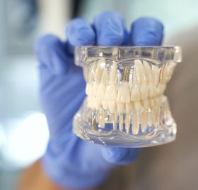 beneficios de los implantes dentales
